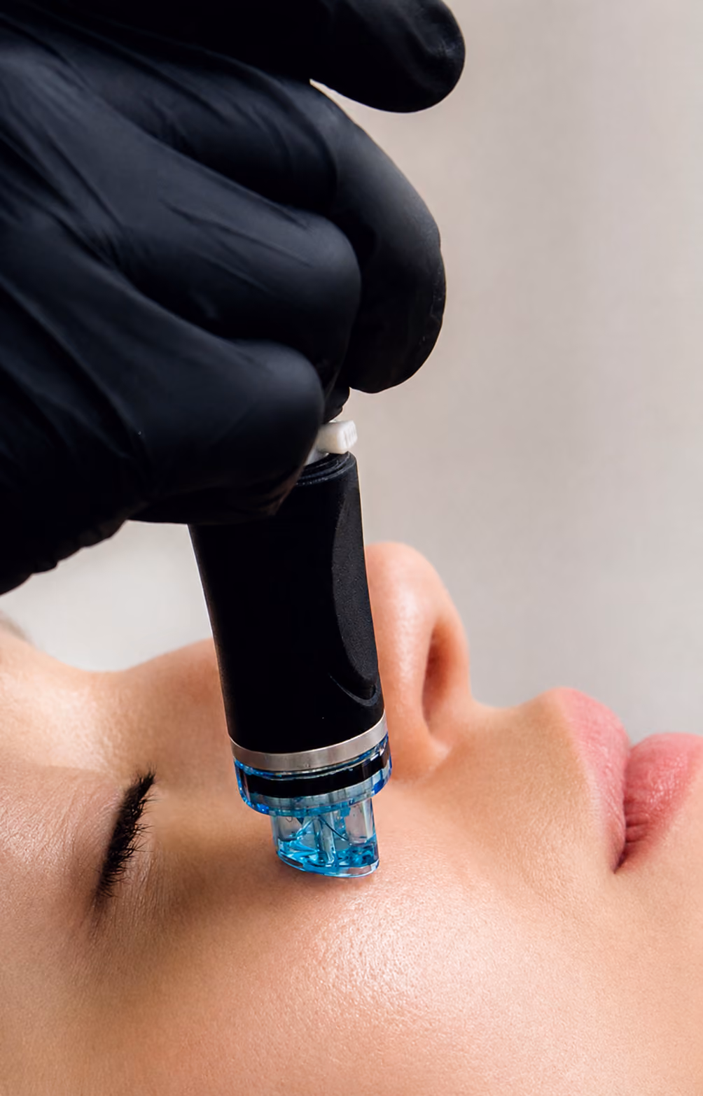 Behandlerin mit schwarzen Handschuhen führt ein Microneedling-Gerät am Kinn durch