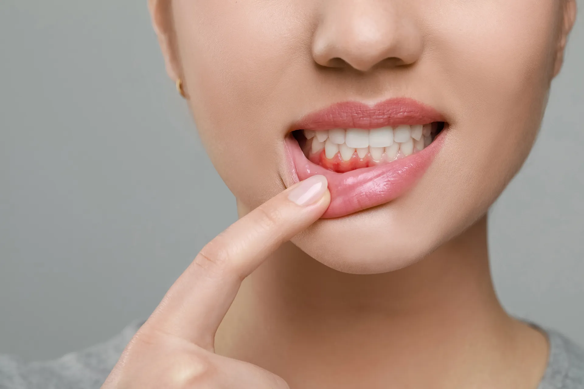 Close-up of a woman pointing to swollen, red gums indicating gum disease.