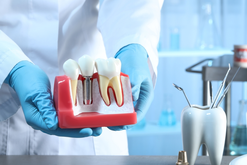 Reasons Why You Should Get a Dental Implant