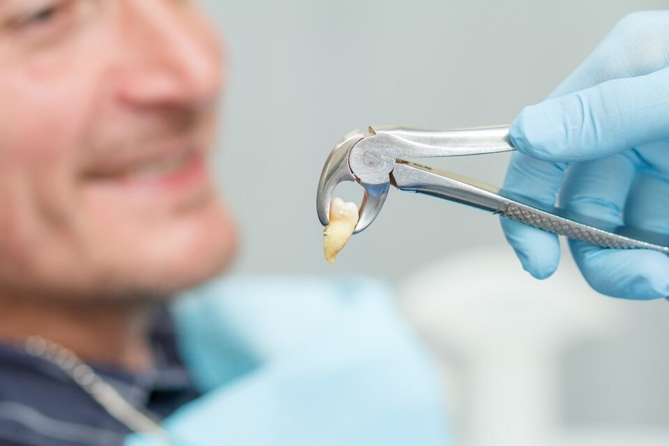Tooth Extraction: What You Need to Know for Speedy Recovery?