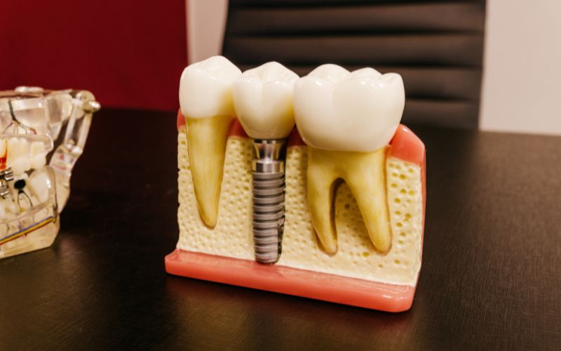 Dental Implants vs. Dentures: Which Tooth Replacement Option Is Right for You?