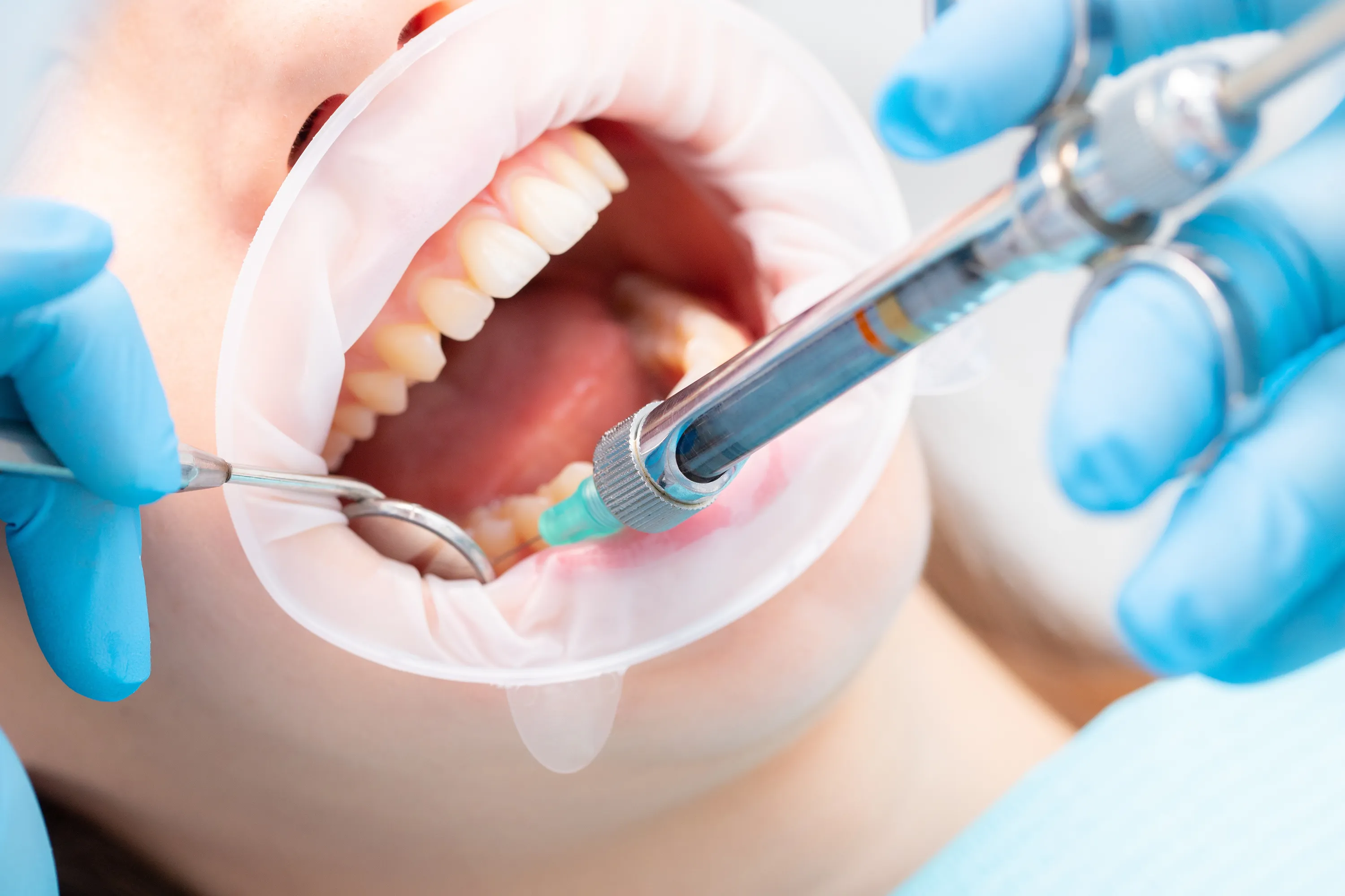 Conscious Sedation
