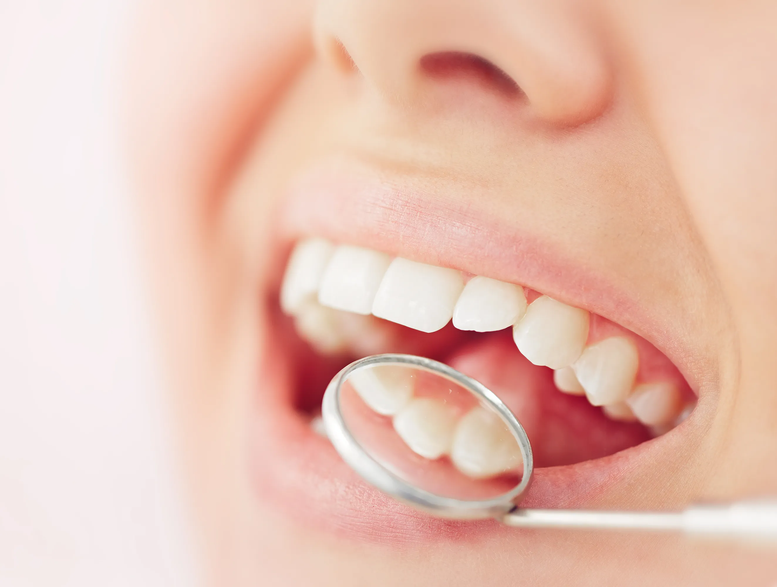 Tooth-Colored Fillings (Composite Fillings)