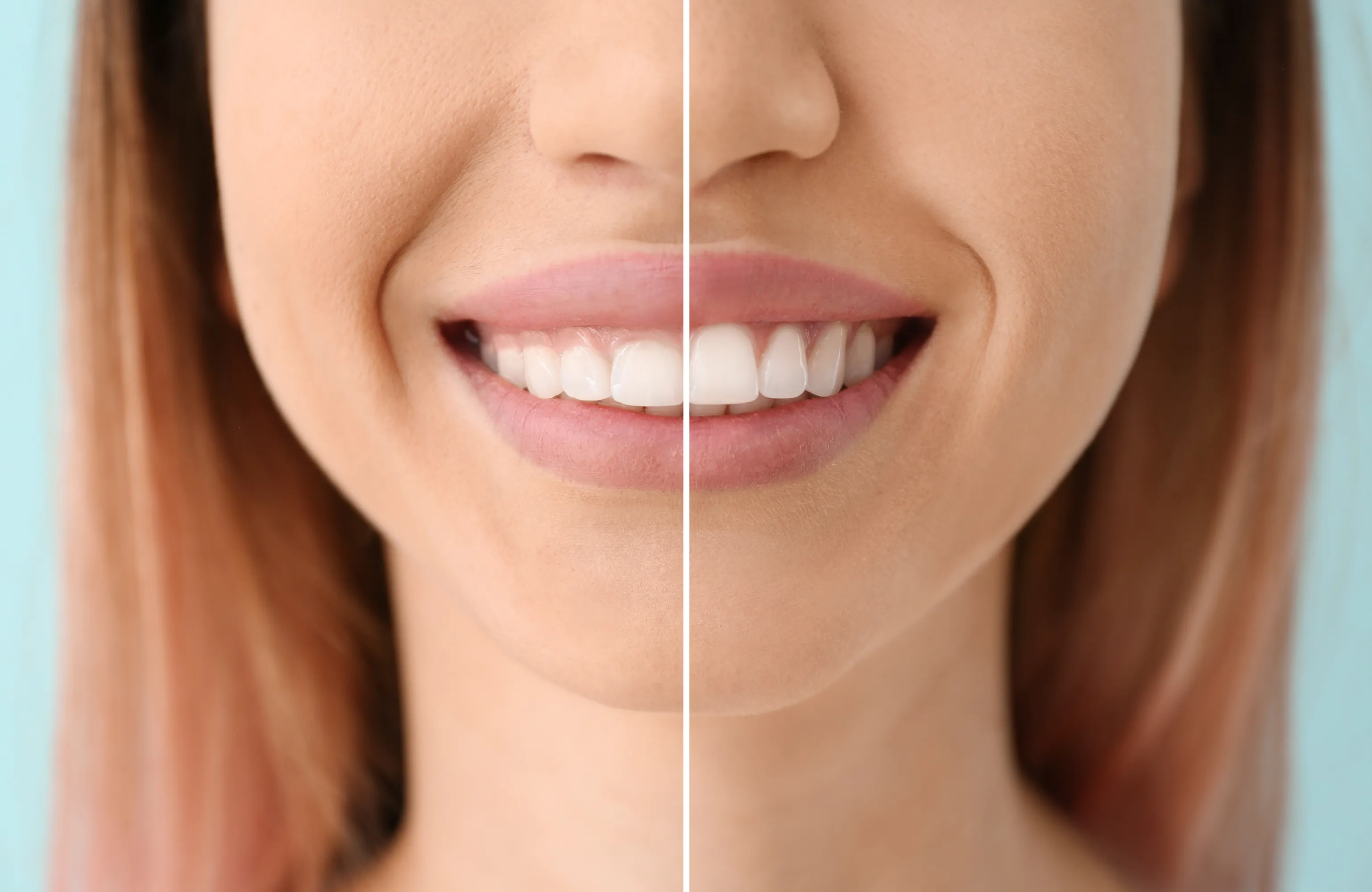 Teeth Contouring & Gum Reshaping