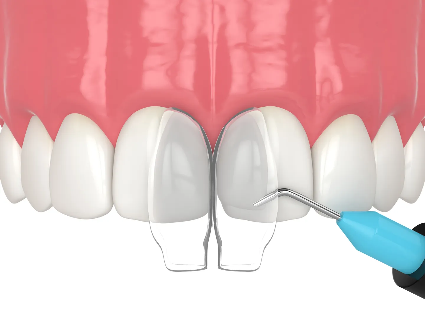 Tooth Bonding