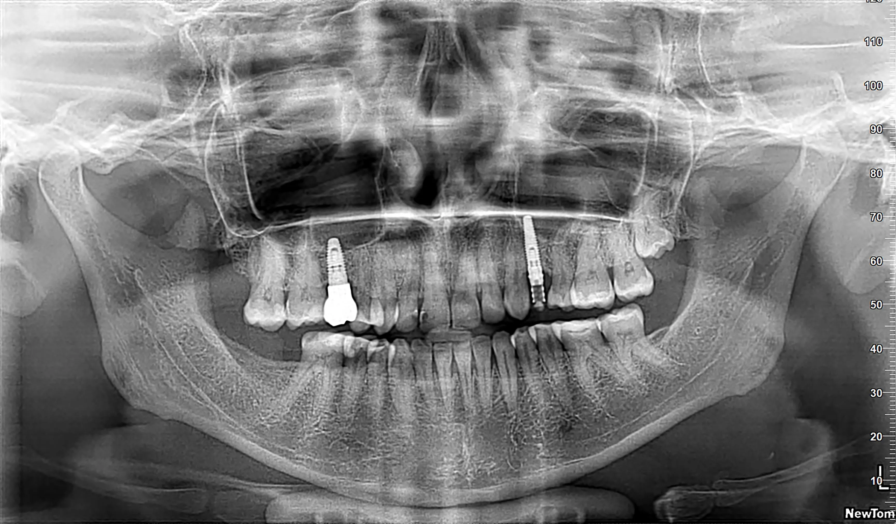 Failed Dental Implants