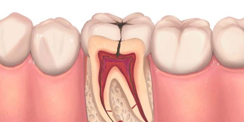 What Is a Root Canal Recovery Like? What to Expect After Treatment
