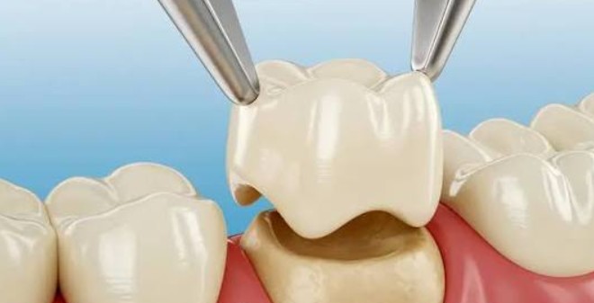 How Do You Know If You Need a Dental Crown? 7 Signs to Watch For!