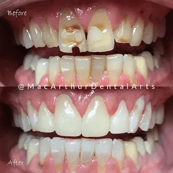 Before and after dental implant restoration of damaged teeth at MacArthur Dental Arts in Irvine, CA