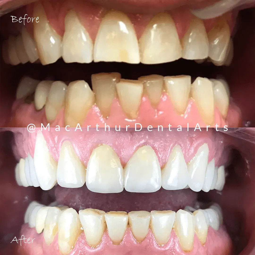 Before and after Invisalign results straightening crowded teeth at MacArthur Dental Arts in Irvine, CA