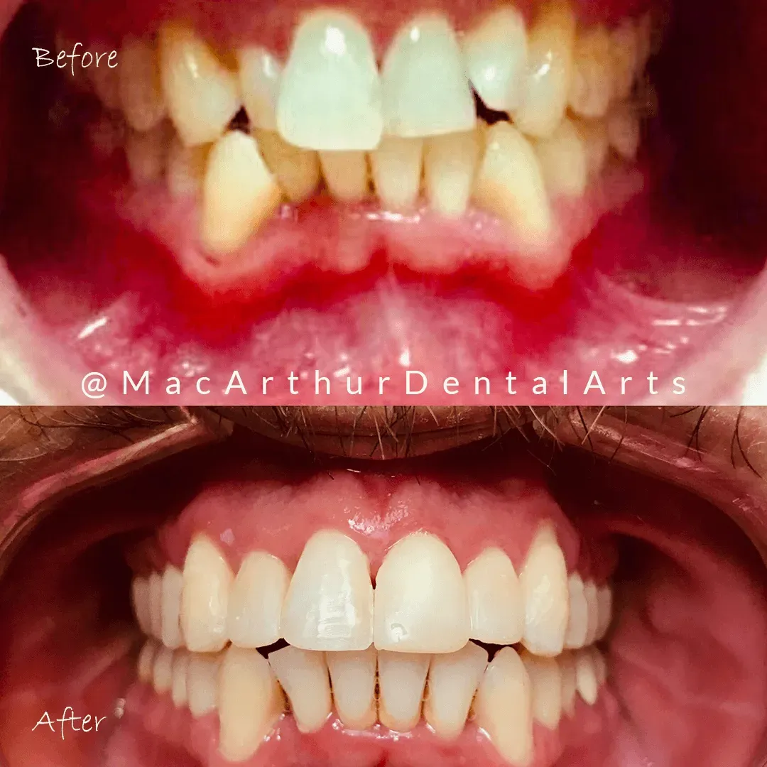 Before and after orthodontic alignment of front teeth at MacArthur Dental Arts in Irvine, CA