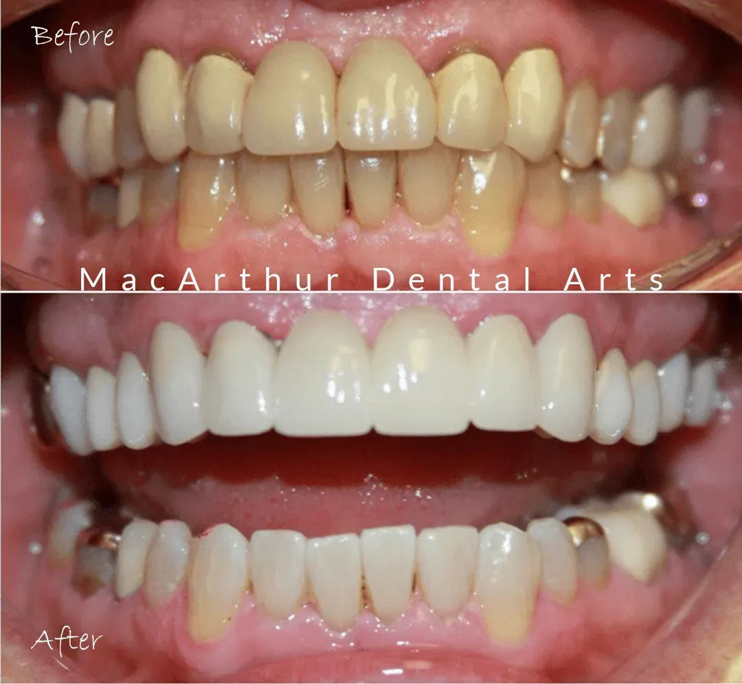 Before and after same-day CEREC crowns and whitening at MacArthur Dental Arts in Irvine, CA