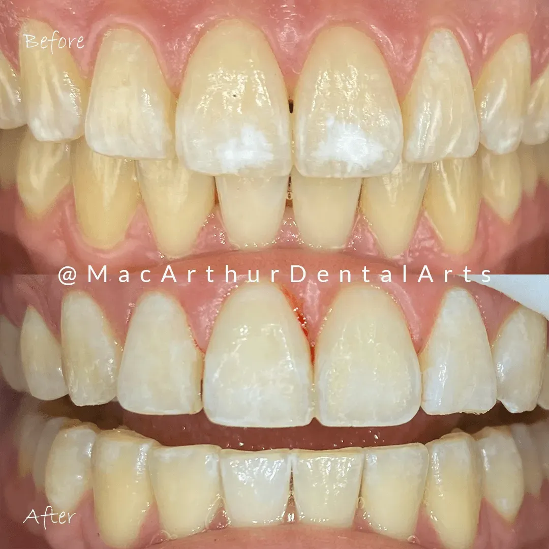 Before and after ICON resin infiltration treatment at MacArthur Dental Arts in Irvine, CA