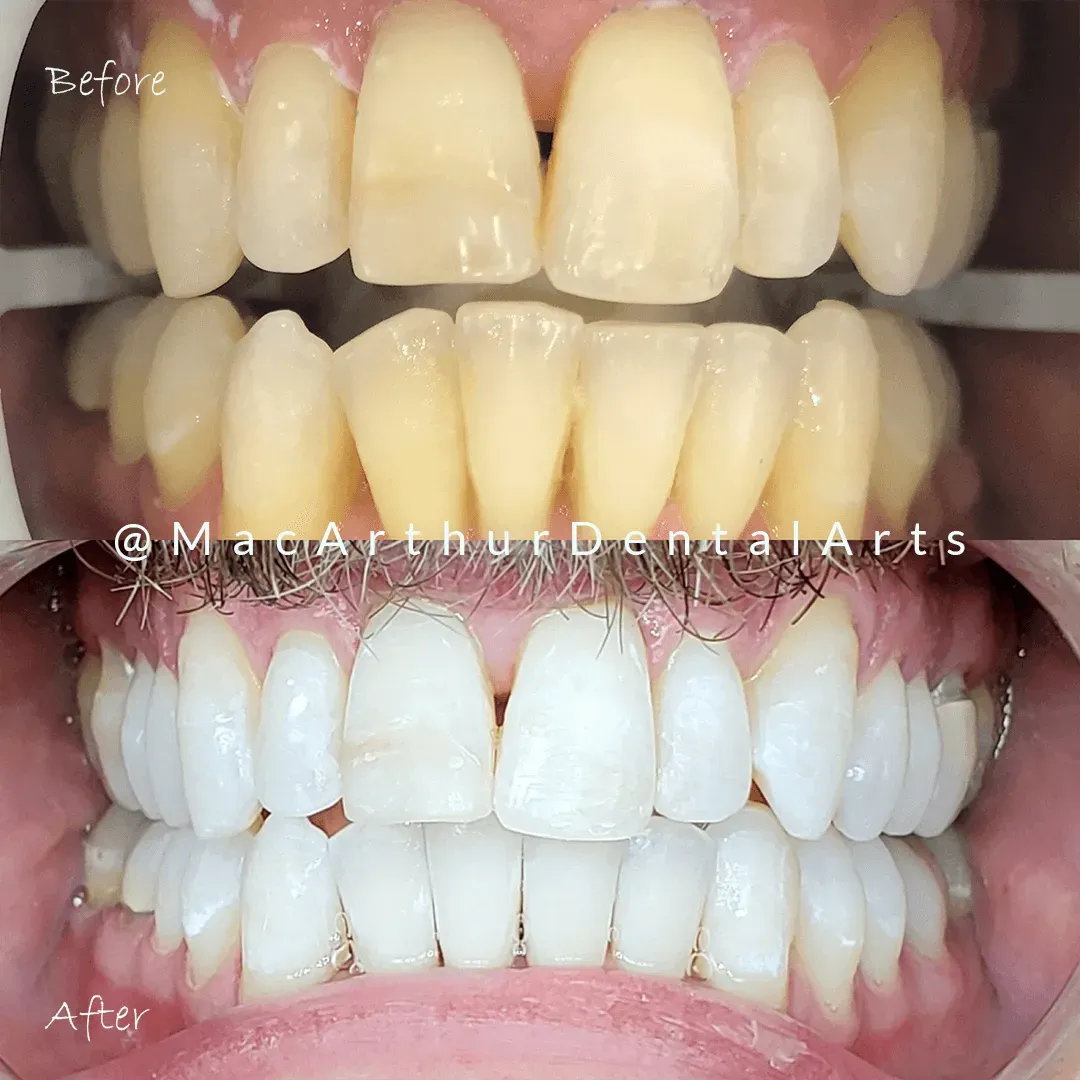 Before and after Zoom teeth whitening at MacArthur Dental Arts in Irvine, CA