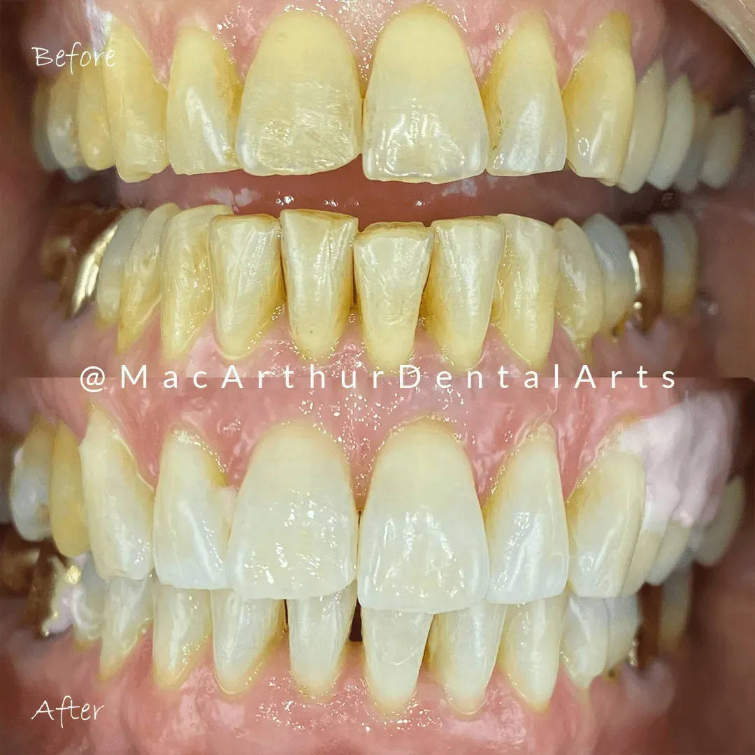 Before and after professional teeth whitening results at MacArthur Dental Arts in Irvine, CA
