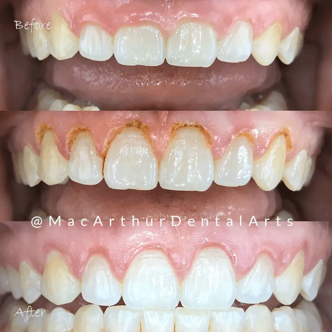 Before and after cosmetic tooth reshaping to close a gap at MacArthur Dental Arts in Irvine, CA
