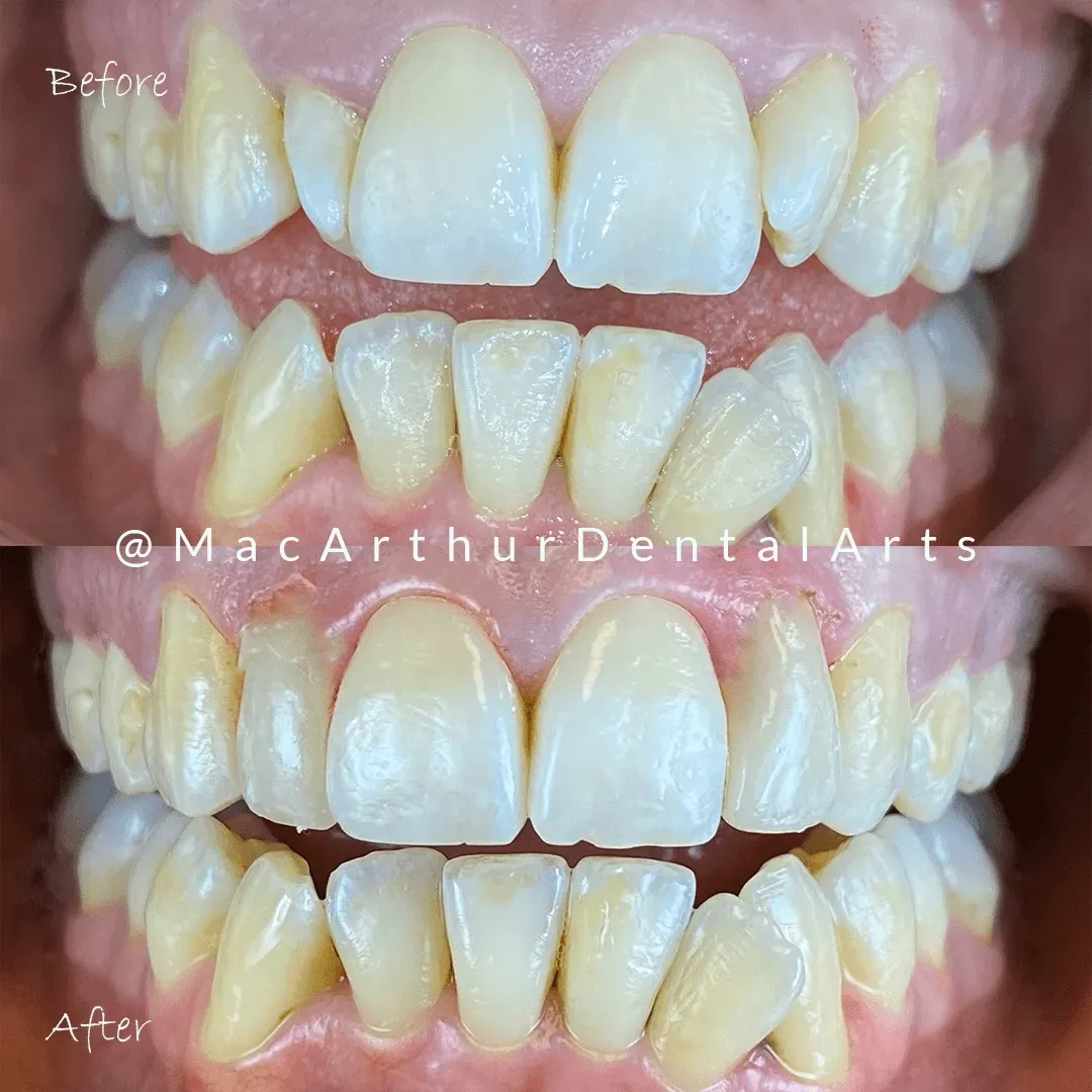Before and after gum reshaping and tooth contouring smile makeover at MacArthur Dental Arts in Irvine, CA
