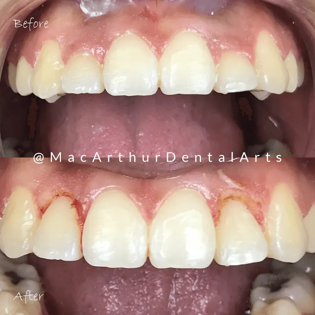 Before and after teeth contouring and gum reshaping result at MacArthur Dental Arts in Irvine, CA
