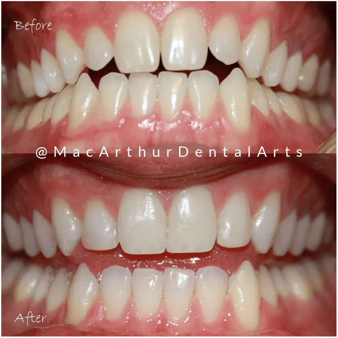 Before and after bonding to close a gap between front teeth at MacArthur Dental Arts in Irvine, CA