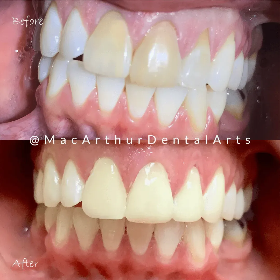 Before and after veneers and bonding results at MacArthur Dental Arts in Irvine, CA