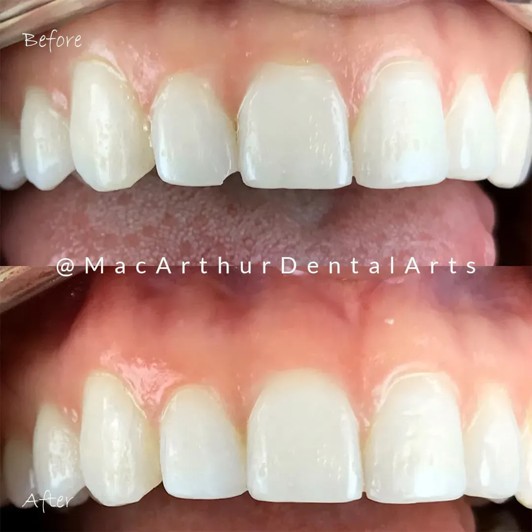Before and after veneers correcting uneven and misaligned teeth at MacArthur Dental Arts in Irvine, CA