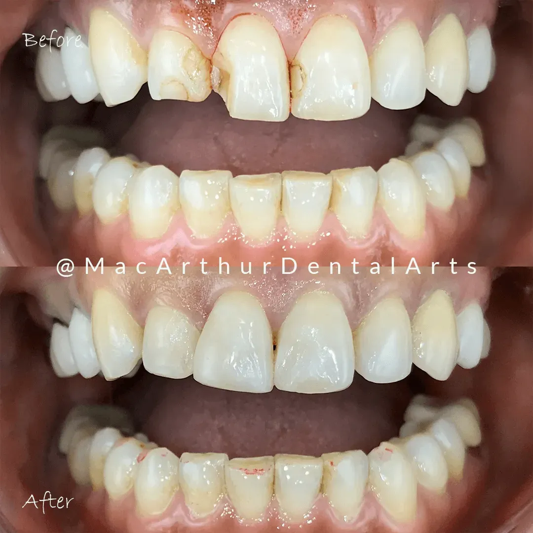 Before and after tooth bonding to repair worn front teeth at MacArthur Dental Arts in Irvine, CA