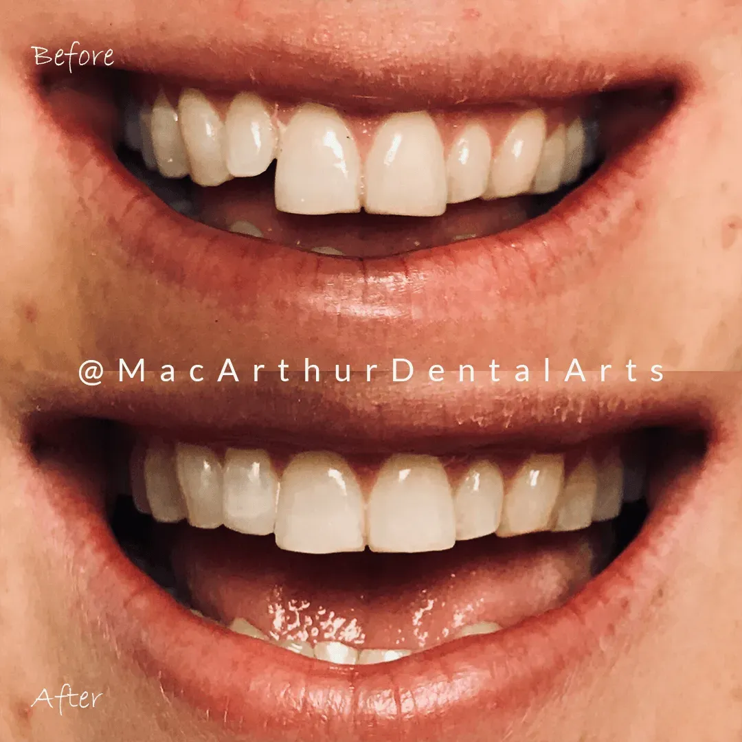 Before and after cosmetic bonding on a chipped front tooth at MacArthur Dental Arts in Irvine, CA