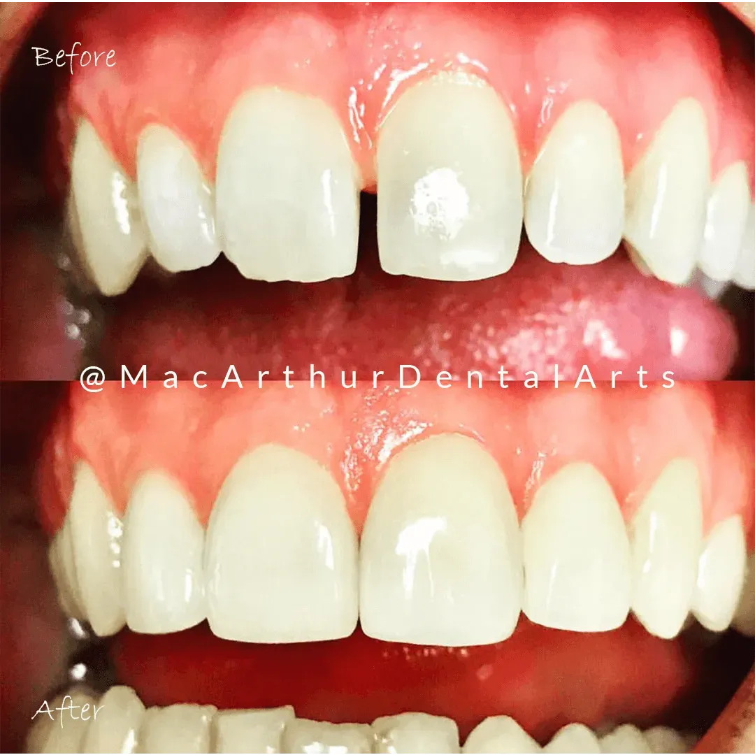 Before and after veneers on front teeth at MacArthur Dental Arts in Irvine, CA