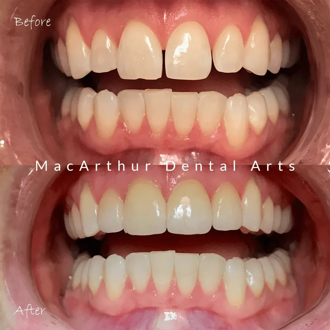 Before and after dental veneers smile makeover at MacArthur Dental Arts in Irvine, CA