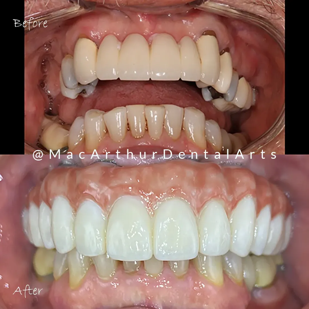 Before and after implant-supported hybrid dentures at MacArthur Dental Arts in Irvine, CA