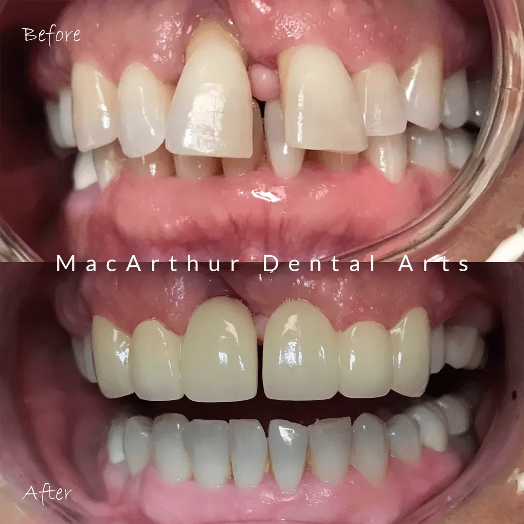 Before and after crown restoration of damaged front teeth at MacArthur Dental Arts in Irvine, CA