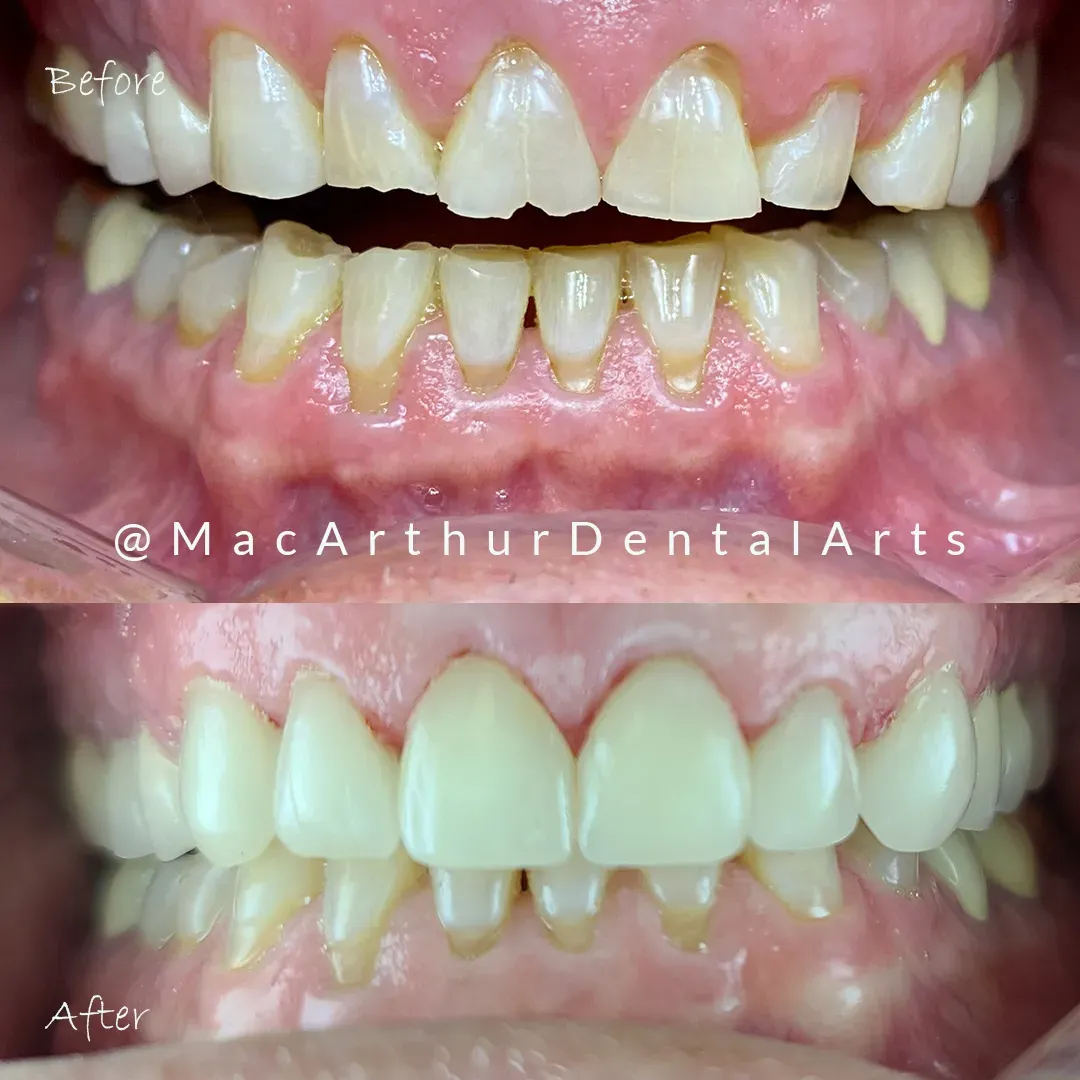 Before and after full-arch crowns and bridgework at MacArthur Dental Arts in Irvine, CA