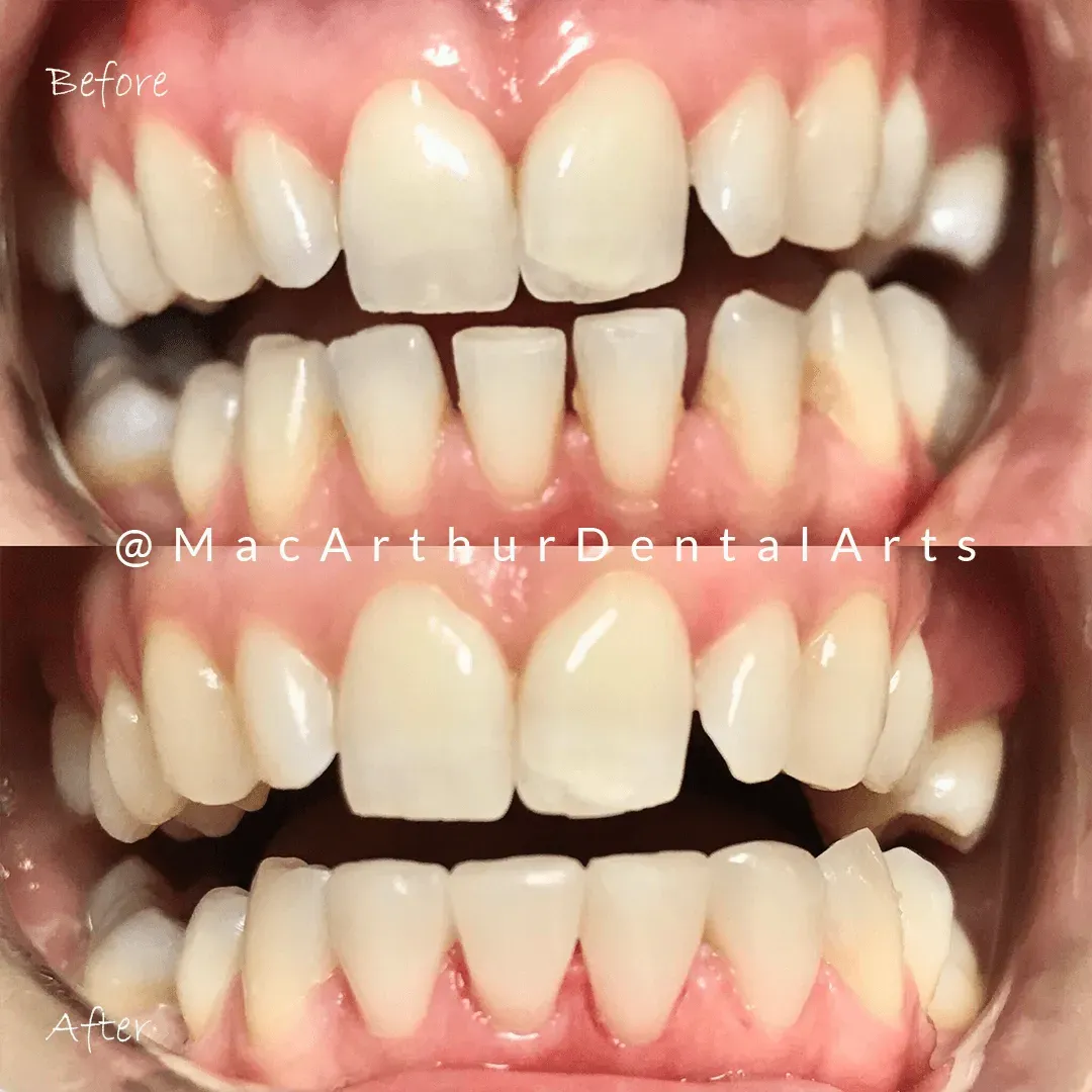 Before and after porcelain crowns on front teeth at MacArthur Dental Arts in Irvine, CA