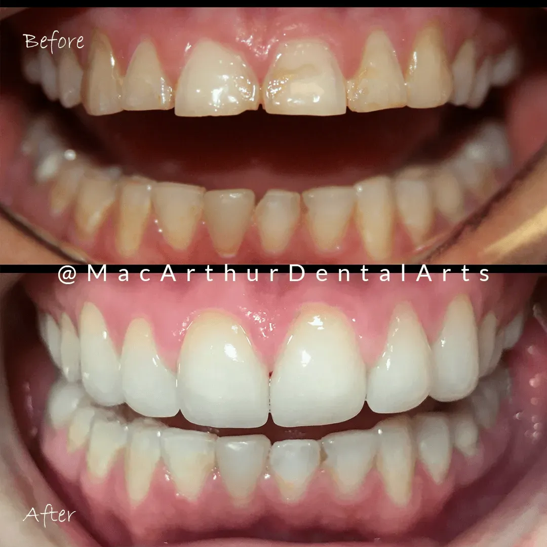 Before and after dental crowns on worn and chipped teeth at MacArthur Dental Arts in Irvine, CA
