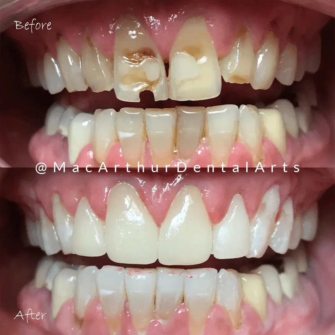 Before and after dental bridge and crown treatment at MacArthur Dental Arts in Irvine, CA