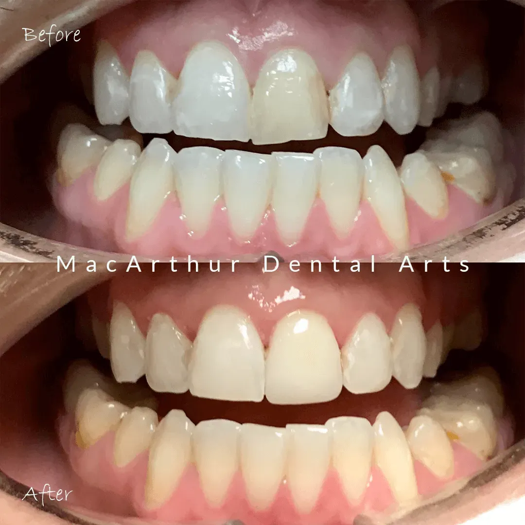 Before and after crowns restoring a smile at MacArthur Dental Arts in Irvine, CA
