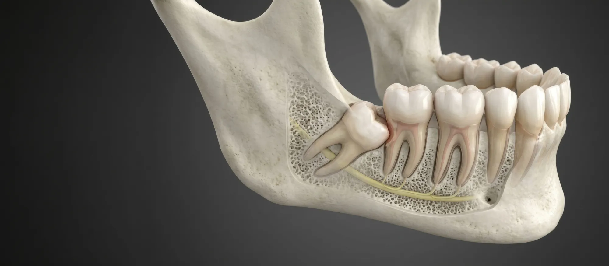 3D illustration of a wisdom tooth in the jawbone before extraction