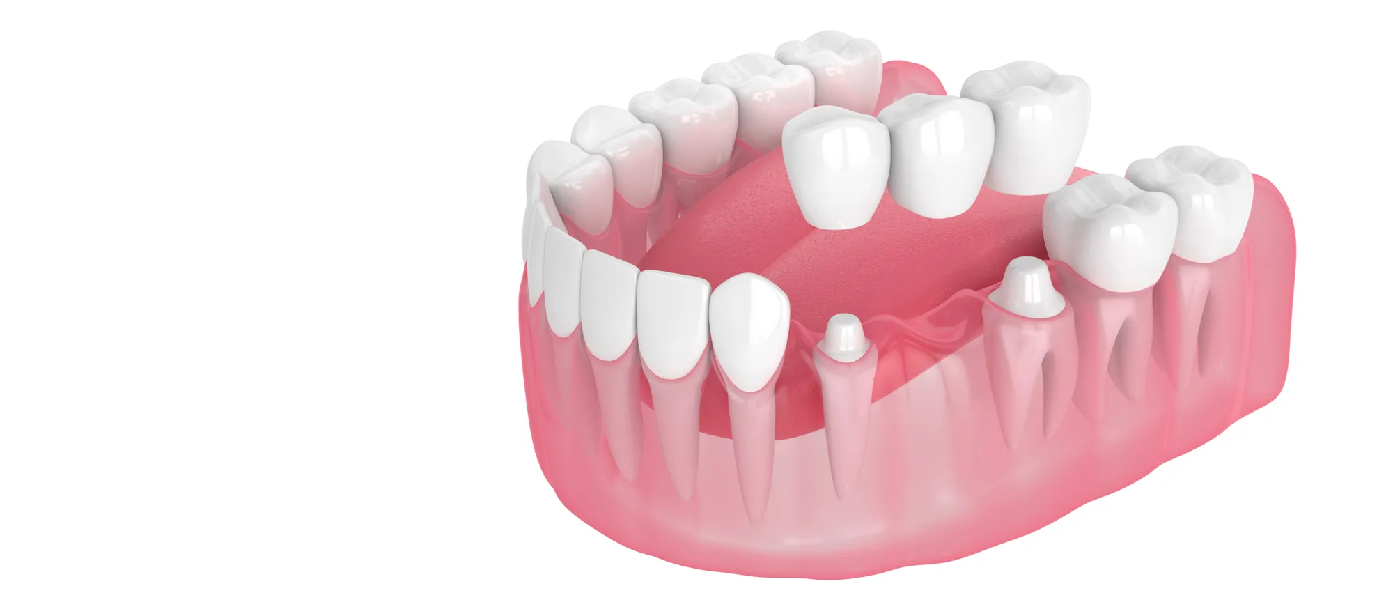3D model of a dental bridge and crowns over prepared teeth