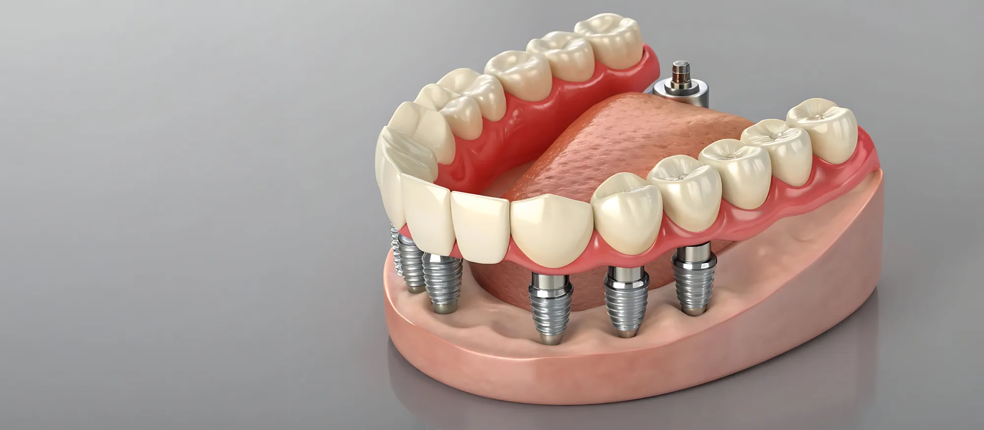 Dental implant model showing implant-supported replacement teeth for Costa Mesa patients