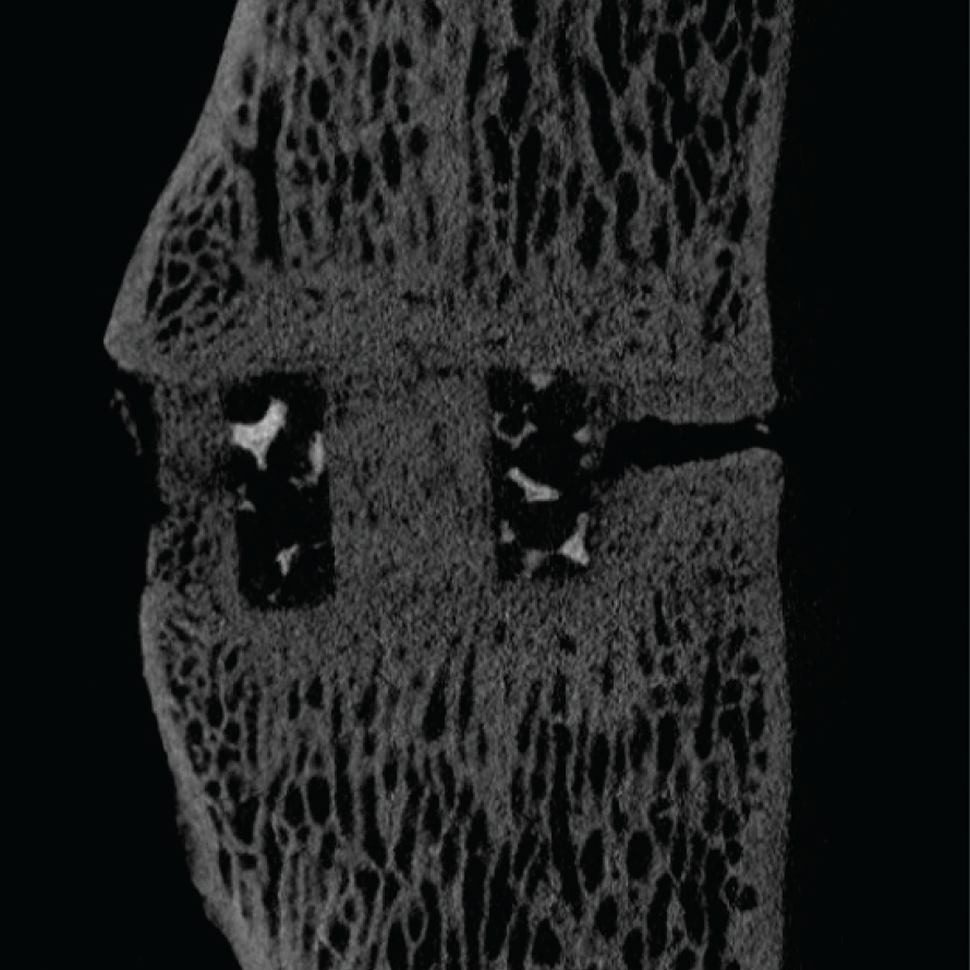 Cross-sectional scan of a vertebral segment with two implants in place.