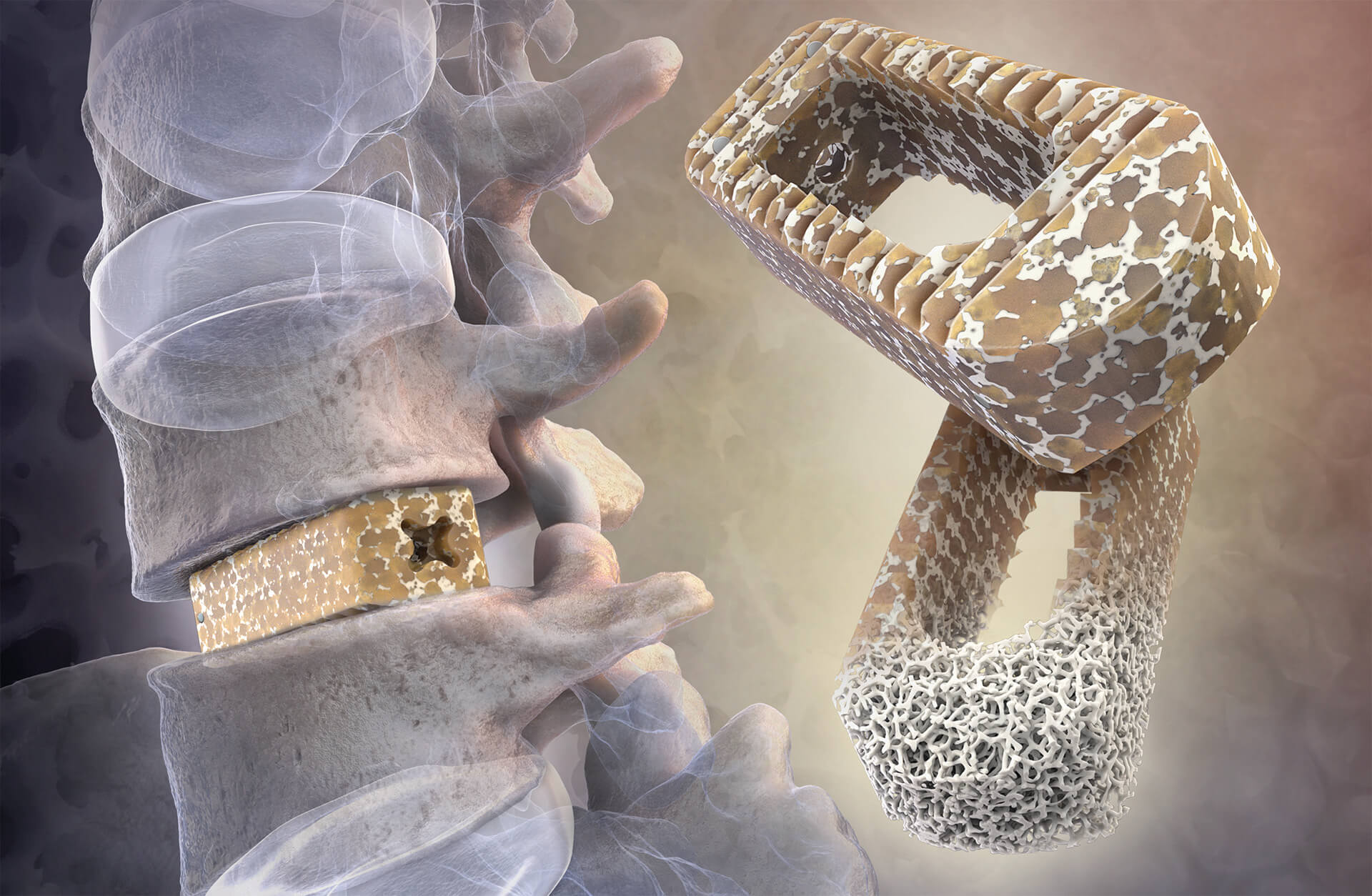 Illustration of an interbody fusion implant between two vertebrae, with a close-up of its porous structure.
