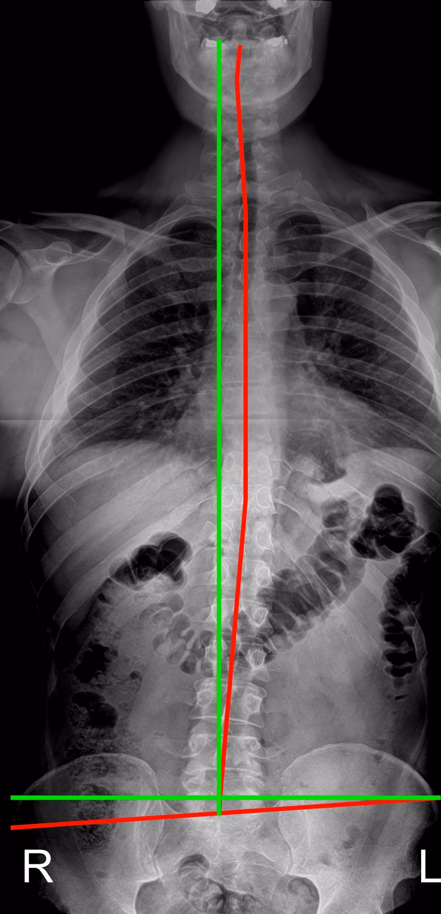 Digital X-ray comparison showing spinal alignment