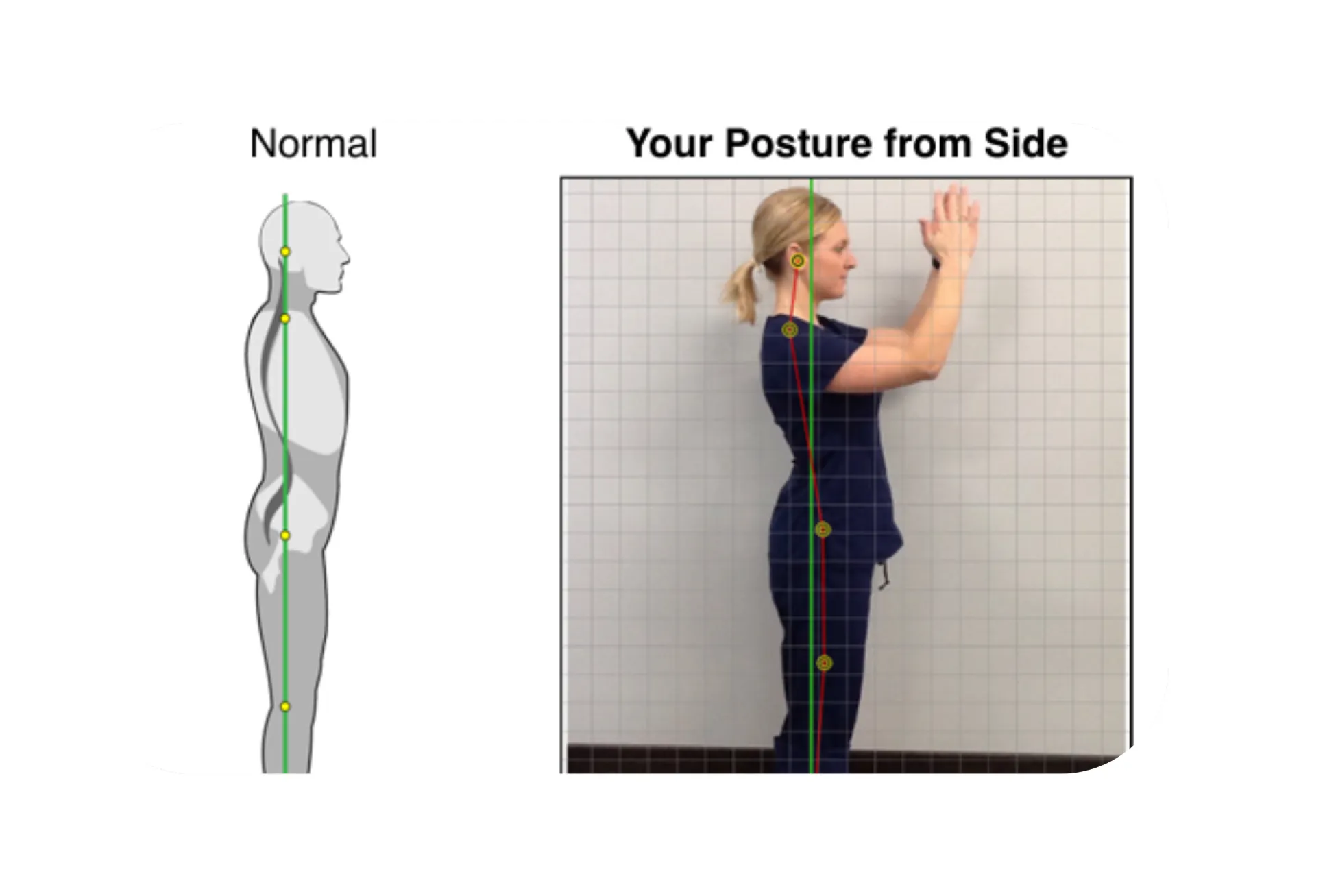 Posture assessment photo used to evaluate spinal alignment