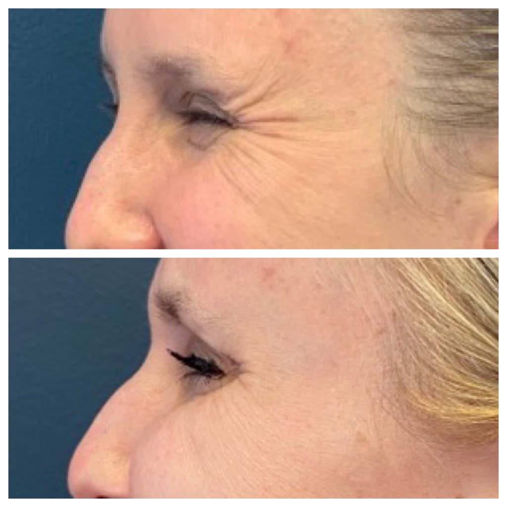 Botox - Crow's Feet