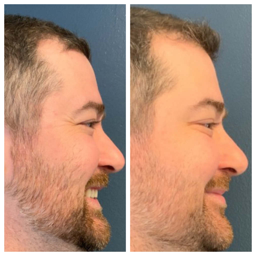 Botox - Crow's Feet
