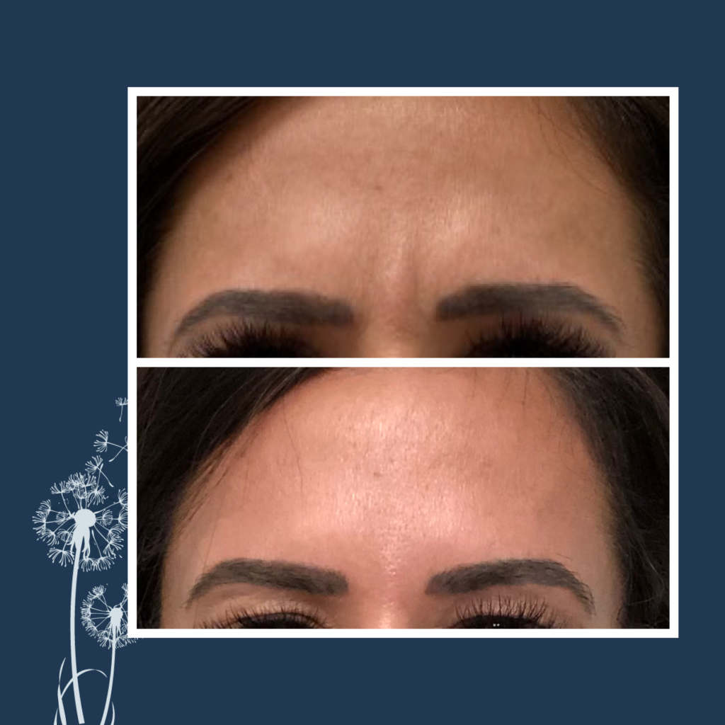 Botox - Forehead