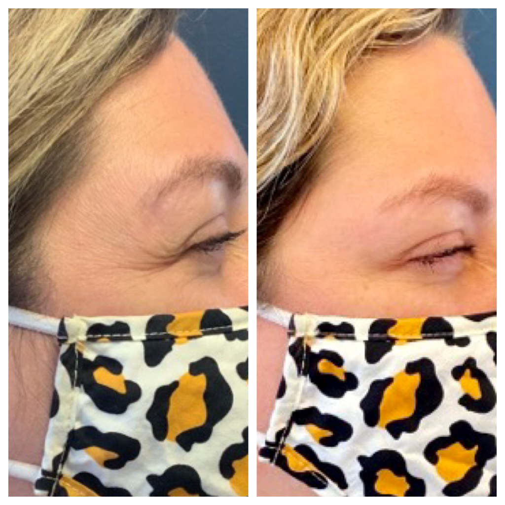 Botox - Crow's Feet