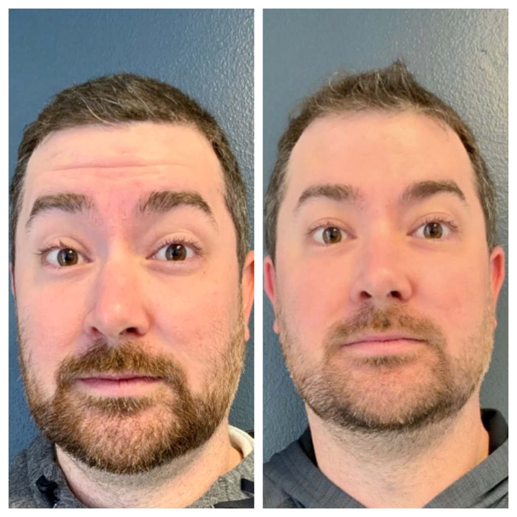 Botox - Forehead