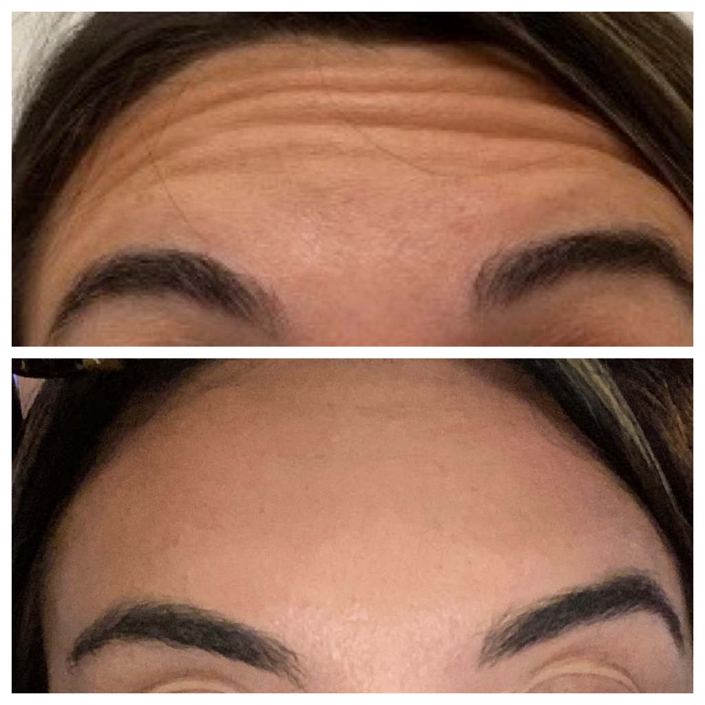 Botox - Forehead