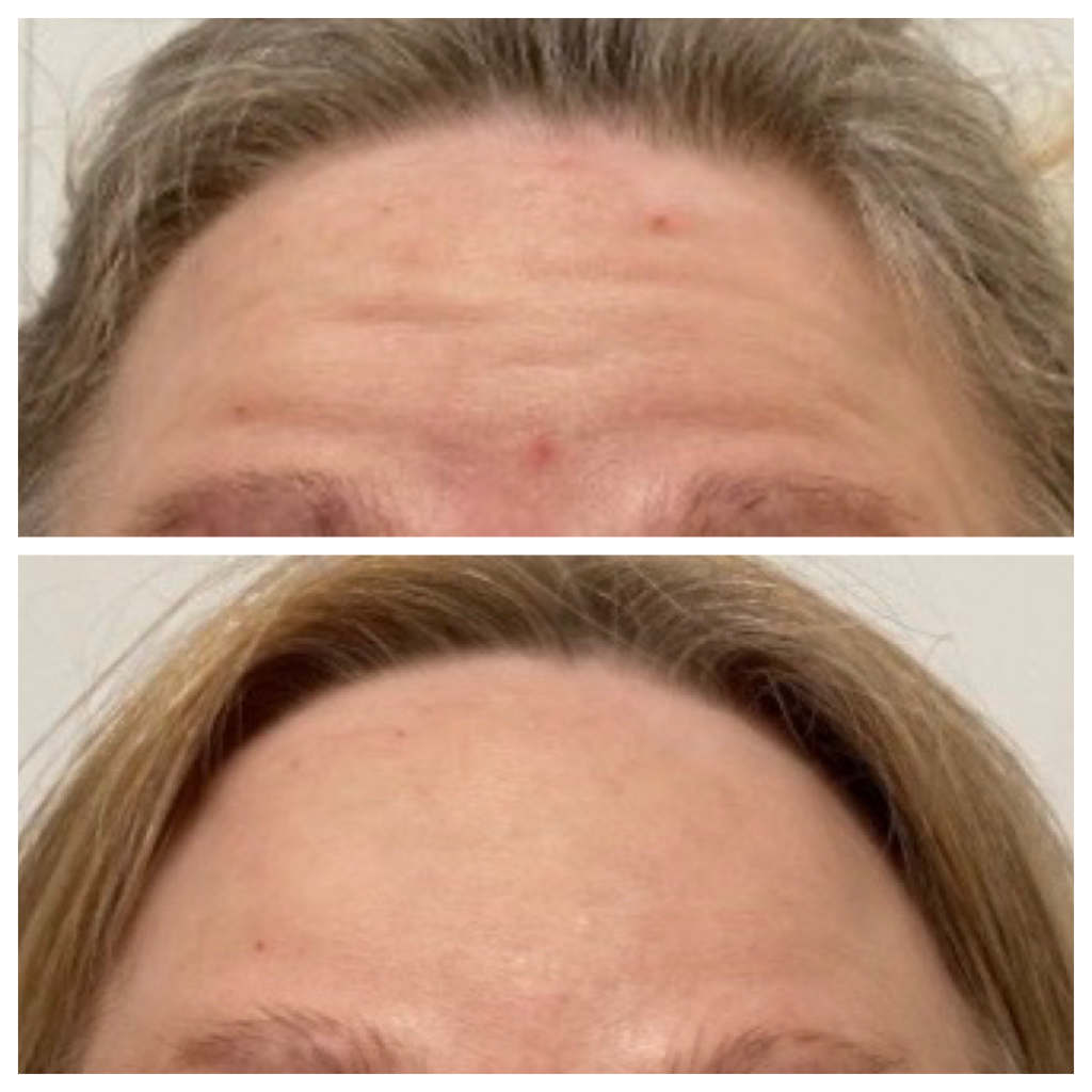 Dysport - Forehead